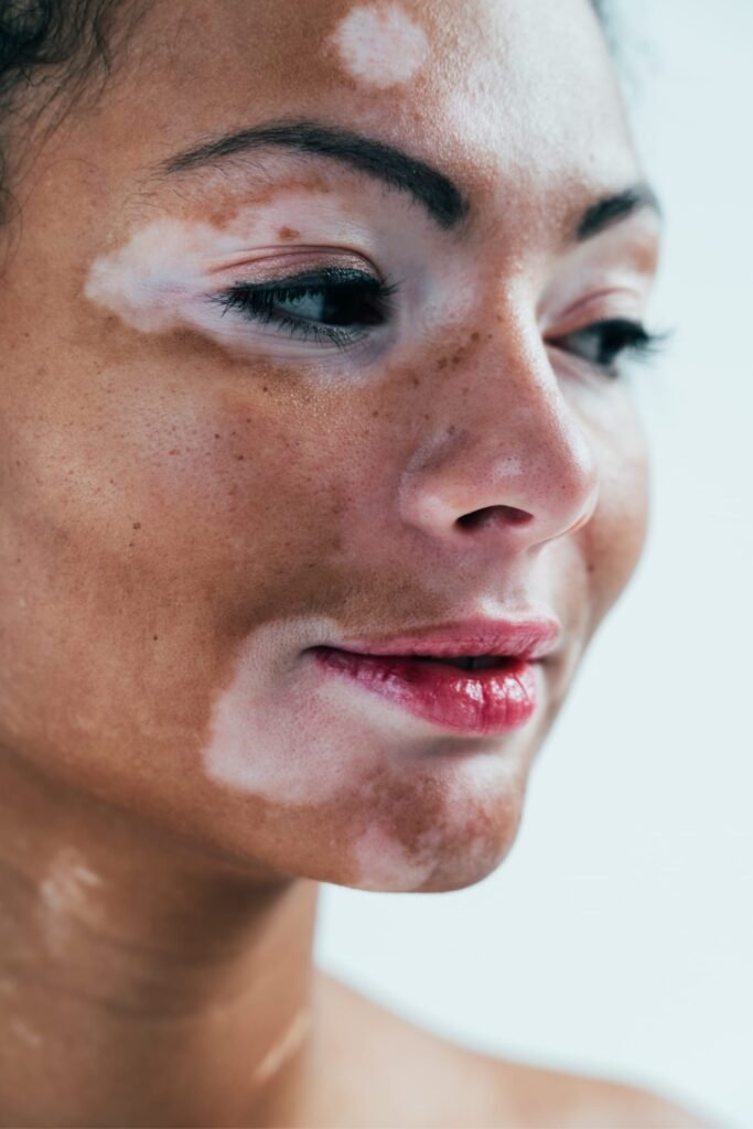 vitiligo surgery